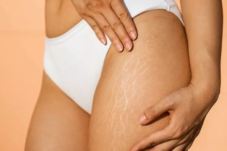 How to tell a guy you have stretch marks