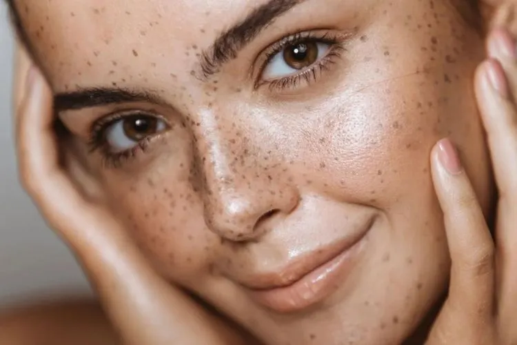 Boosting Confidence in Freckles